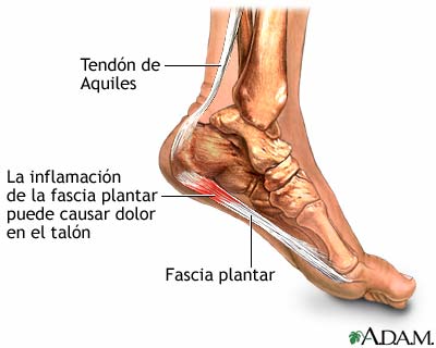 fascitis-plantar